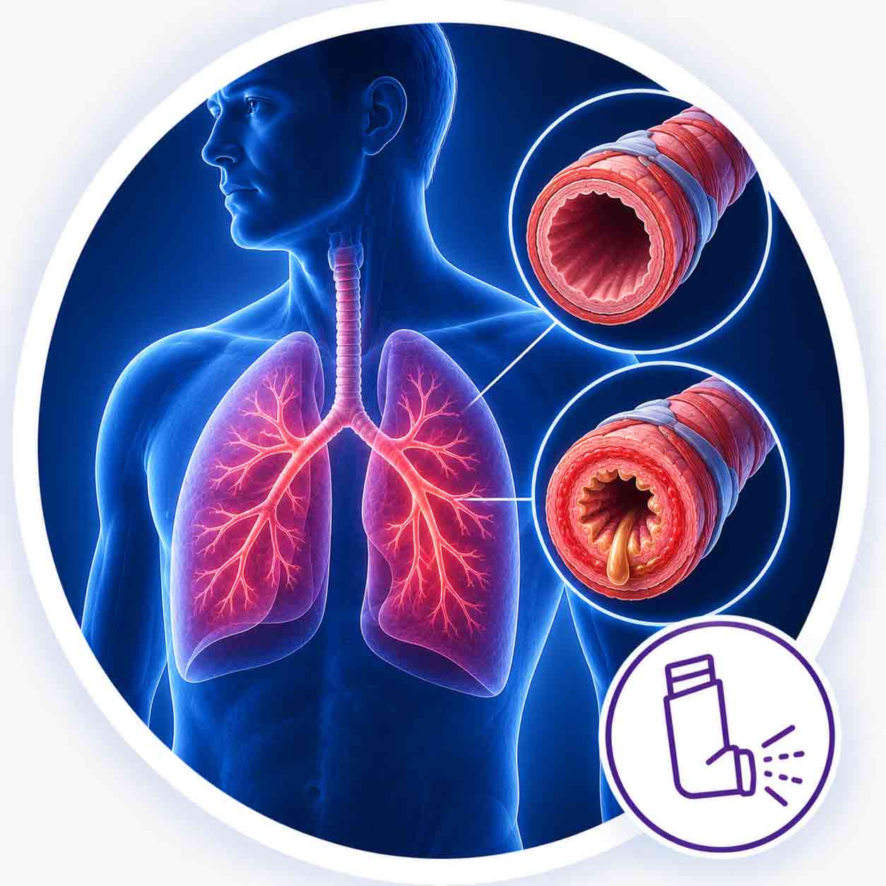 Asthma