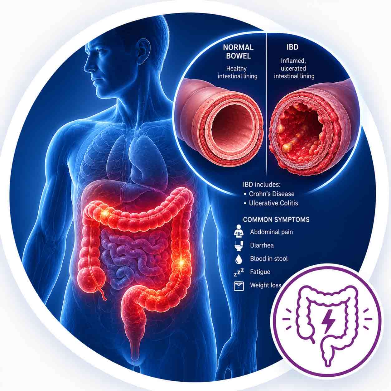 Inflammatory Bowel Disease (IBD)